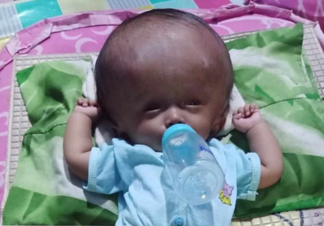 Idap Hydrocephalus, Putri Olivia Pransiska Butuh Uluran Tangan Dermawan Idap Hydrocephalus, Putri Olivia Pransiska Butuh Uluran Tangan Dermawan